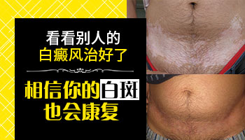泛发型白癜风还能治好吗