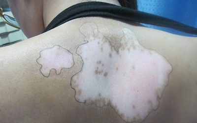 白癜风黑色素种植后的颜色