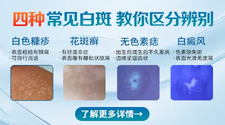 脸上有白斑要凃什么药膏