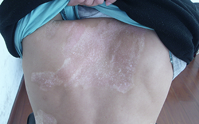 白斑边界模糊或清楚有什么区别