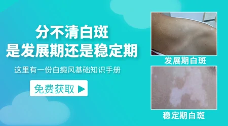 白癜风进入发展期会出现哪些症状