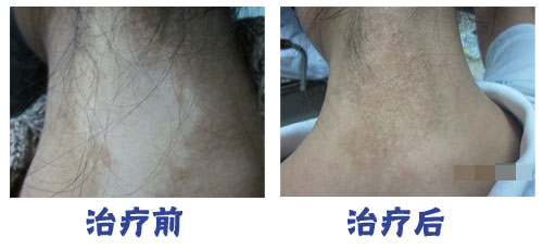 为什么白癜风总是久治不愈