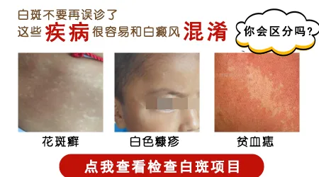 初期白癜风白斑高清实拍图