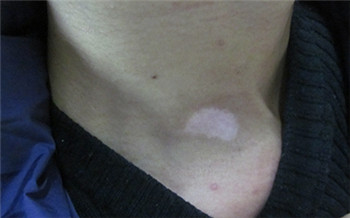 轻度白癜风症状图片是怎样的