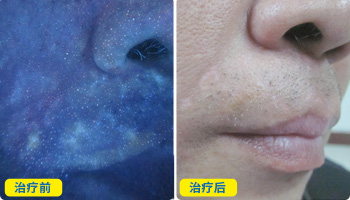 伍德灯下整个嘴唇都是白的