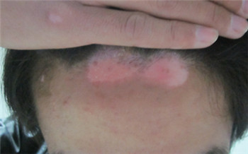 发际线处长白斑可能是什么