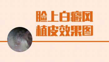 白癜风植皮痛苦吗 植皮效果怎么样