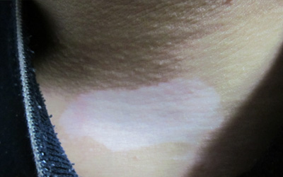 小孩胸部皮肤白斑是什么