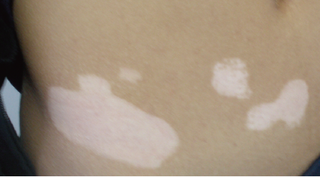 白斑初期症状 身上白块就是白癜风吗