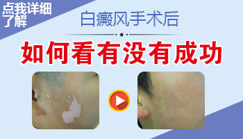 白癜风手术一个月没变黑是不是没成活