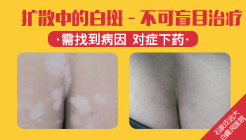 怎样避免白斑发展