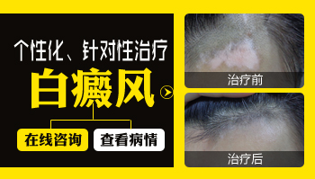 白癜风治疗后期恢复效果慢怎么解决