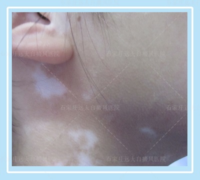 宝宝脖子褶皱处白色的斑点是什么