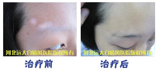 眉毛部位白癜风治好的案例图