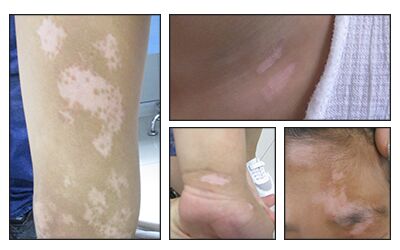 白癜风中药调理的效果怎么样