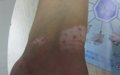 男性手腕上长白斑不疼不痒是什么
