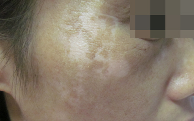 脸上长白斑是怎么回事 白斑图片对比