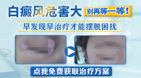 儿童白斑和白癜风区别是什么样子