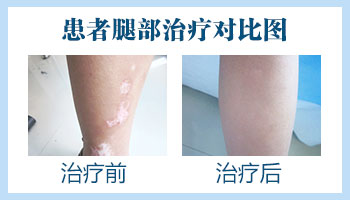 家用308激光治疗仪值不值得买