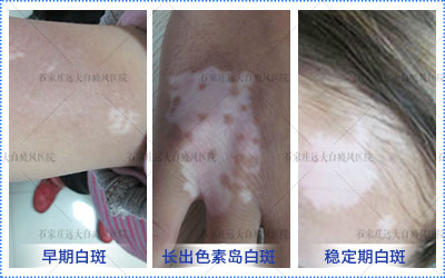 稳定期白癜风影响要孩子吗