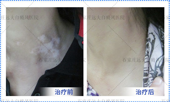 小孩脖子白斑 有白斑是不是白癜风