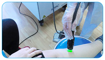 308准分子激光治疗白癜风需要住院吗