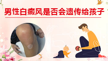 爸爸有白癜风孩子要去检查吗