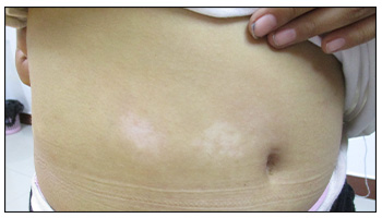 两个月的宝宝身上有米粒大白点是什么