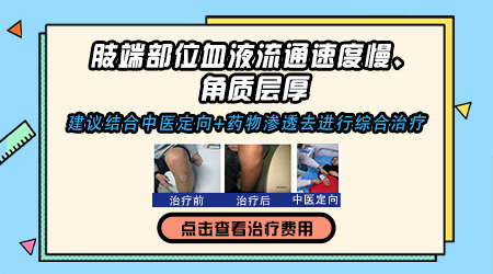 手脚白癜风扩散了怎么治