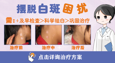 白癜风患者能吃烧烤吗