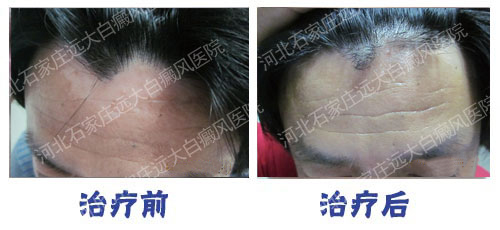 308激光治疗白点恢复的图片