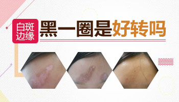 白癜风的白斑边缘有一圈黑的