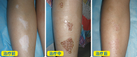 白癜风移植手术十天后的图片