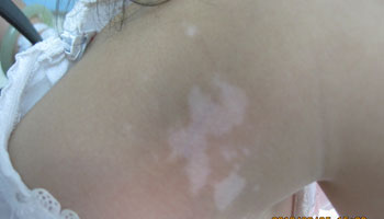 颈部长白斑图片 颈部白斑的原因是什么