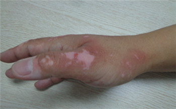 手指关节痒后变白是白癜风吗