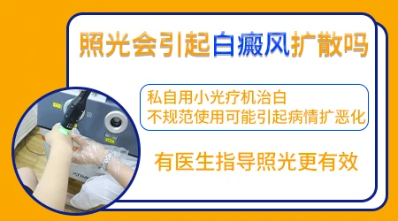 白癜风光疗会加速白斑扩散吗