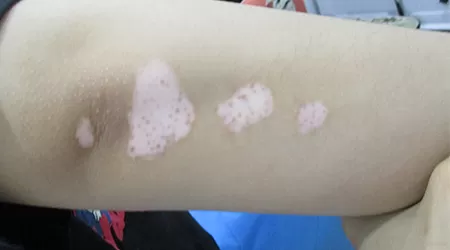 胳膊白斑是不是白癜风 符合这几个白癜风症状就是