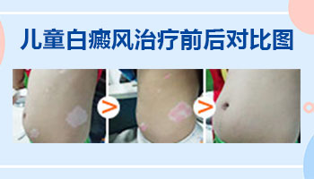 儿童背上白癜风喝中药能调理好吗