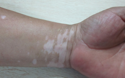 宝宝手腕上有一块皮肤白