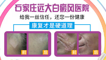 邢台白癜风医院哪家好 白癜风治疗好医院