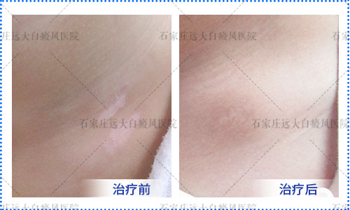 白癜风医院光疗灯的价格