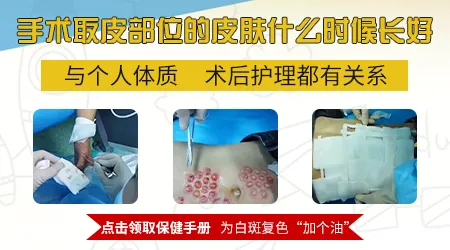 白癜风手术取皮后供皮区会不会也长白斑