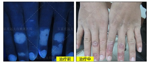 双手都是白癜风能不能治好 怎么治
