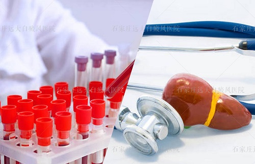 确诊白癜风要做的检查有哪些