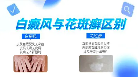 花斑癣白斑与白癜风对比图片