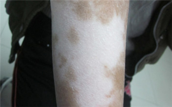 白斑初期症状图片 白斑不治会怎样