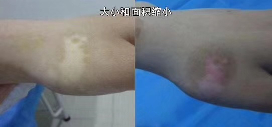 白癜风怀孕期间可以用308光疗机吗