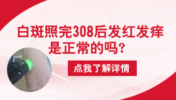 308激光照白癜风发红发痒正常吗