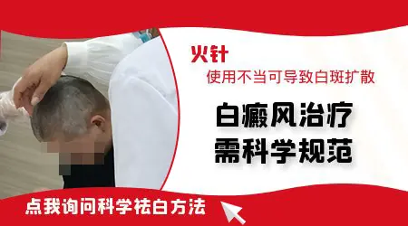 中医火针治疗白癜风有效果吗
