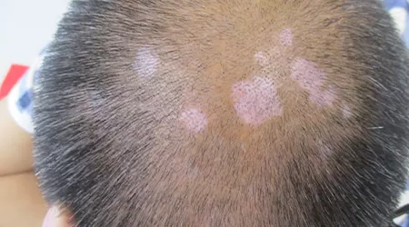 头皮有白点点是怎么回事